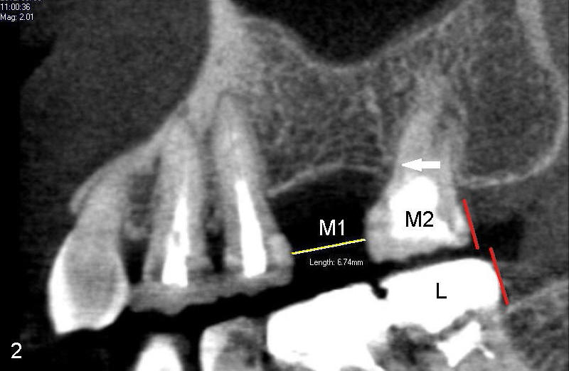 braces-before-implant-design-tooth-shifts-after-neighboring-tooth-extraction-mini-implant